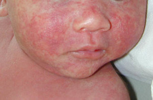 Atypical-Measles